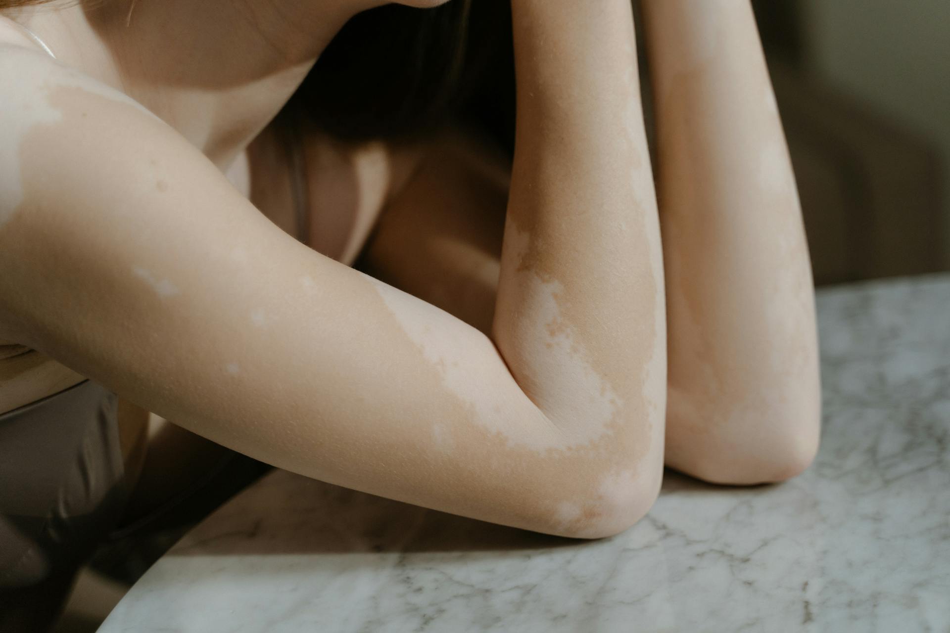 a woman with arms waiting for a meline peel