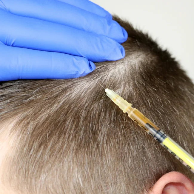 A man receiving Mesotherapy hair treatment at Laviel clinic a needle can be seen injected into the scalp
