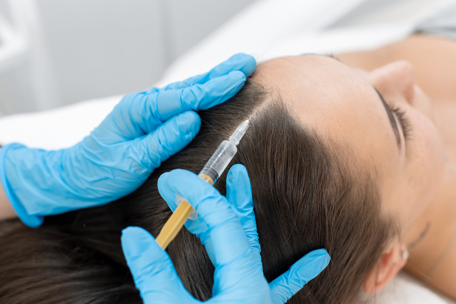 A woman getting PRP head treatment injection