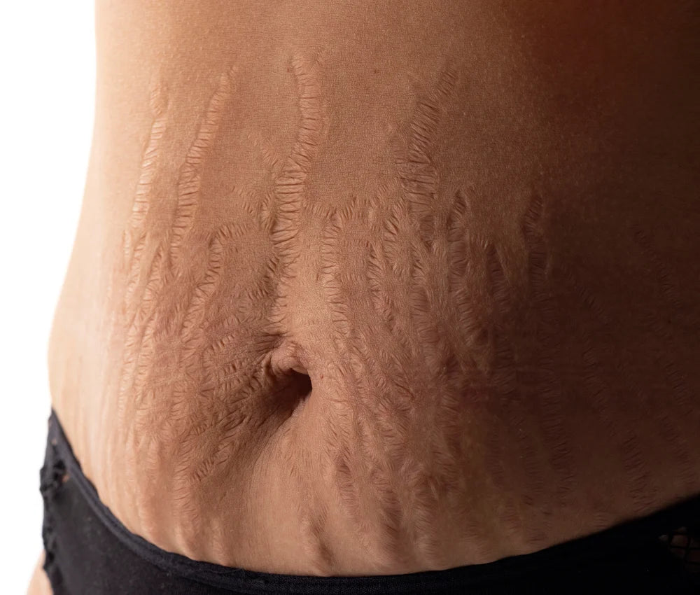 Stretch marks on a woman's stomach area