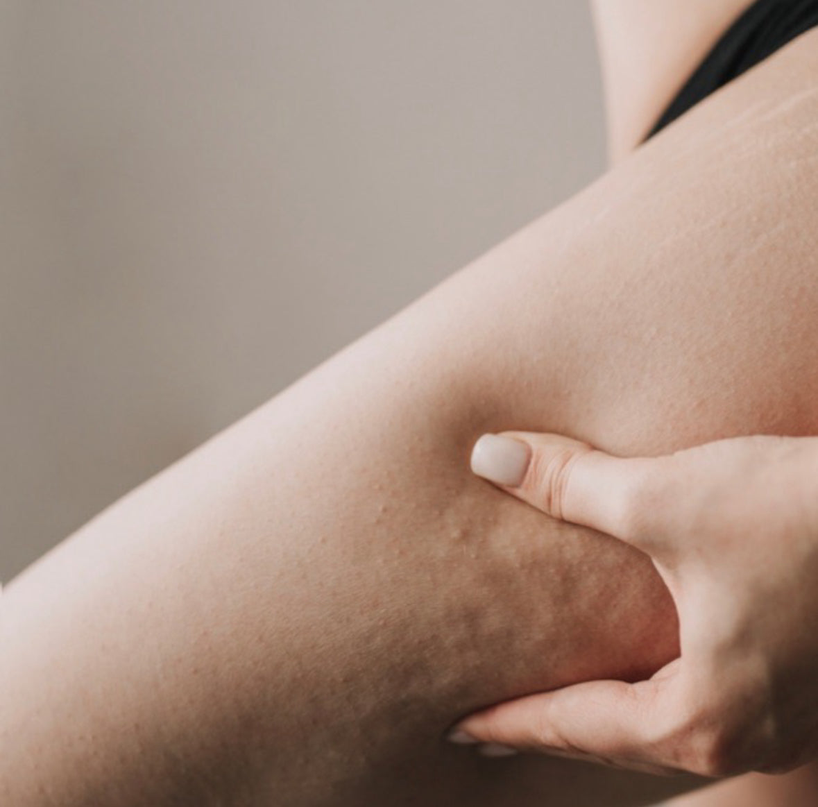 A woman squeezing her arm showing cellulite under the skin